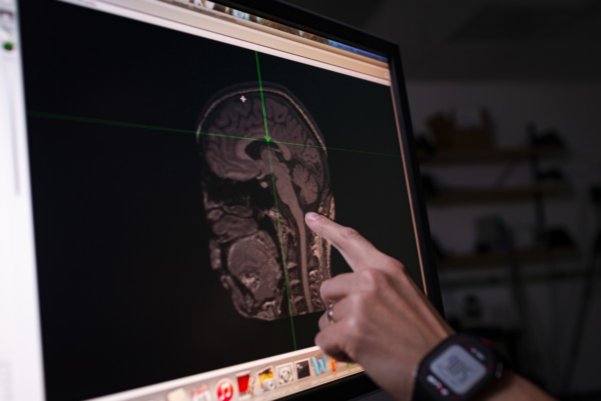 Researchers study the effects TMS has on post-stroke depression